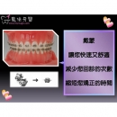 戴蒙矫正器 - Dental Orthodontic-12