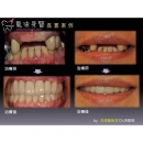 牙齿缺牙 - Dental Implants-21