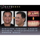 缺牙 - Dental Implants-20