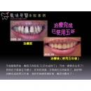牙周病疗程 - Dental Laser-3