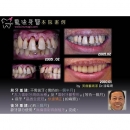牙周病治疗方法 - Periodontal Disease Treatment-1