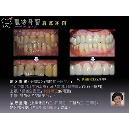 植牙好处 - Dental Implants-17