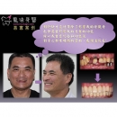 全口重建费用 - Full Mouth Reconstruction-1