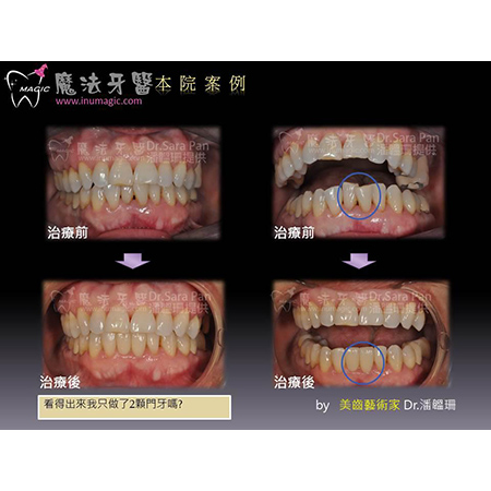 牙齿拥挤 - Dental Esthetics-5