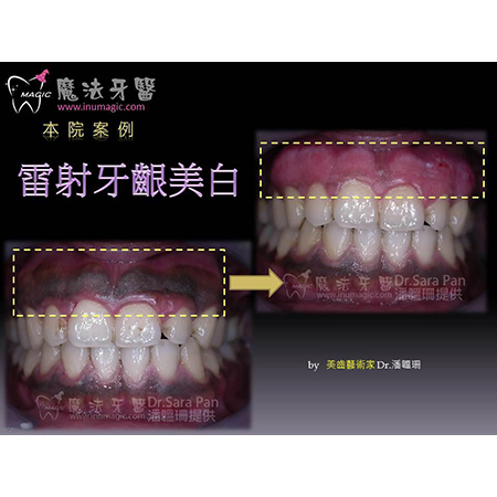 牙龈变白 - Dental Esthetics-3