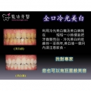 居家美白 - Dental Esthetics-14