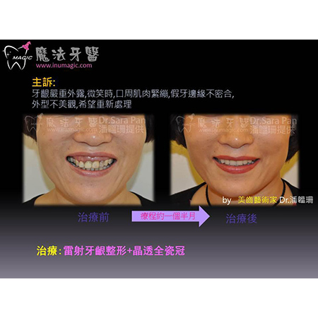 牙齿重建 - Full Mouth Reconstruction-6